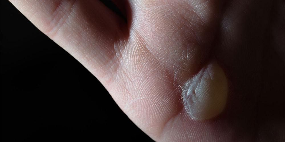 5 orsaker till blåsor i huden och hur man behandlar den på rätt sätt
