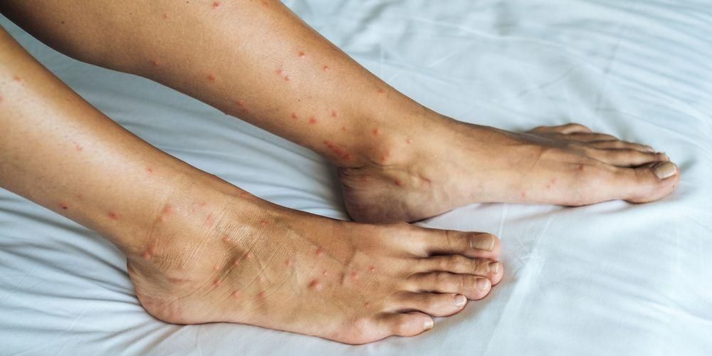 Petele roșii de pe picioare pot fi cauzate de aceste 9 boli