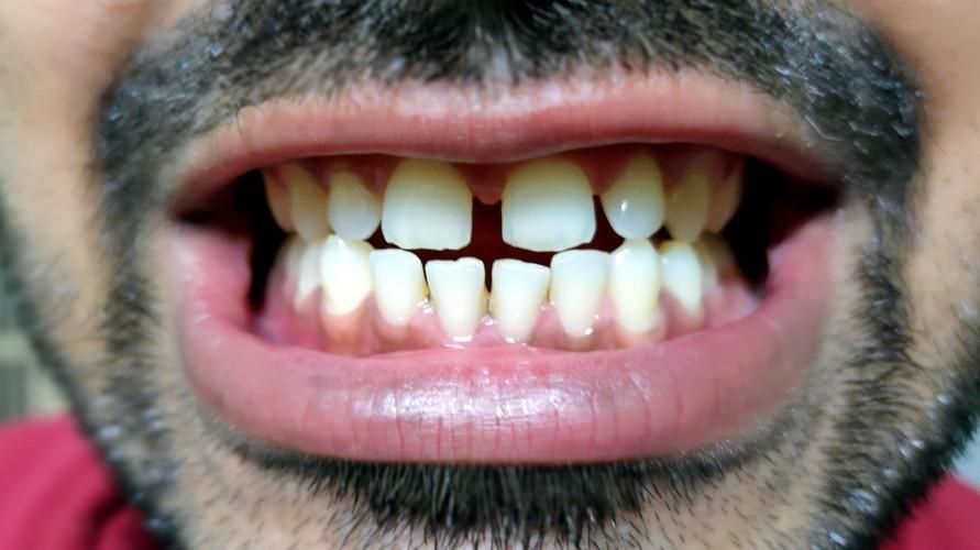 Как избавиться от редких зубов посередине, чтобы зубы были красивее