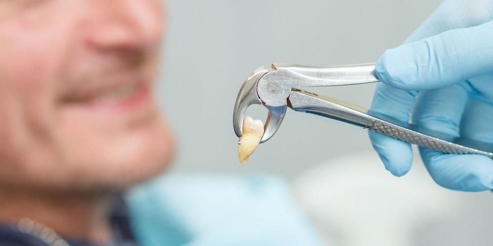 זהו טווח העלויות לעקירת שן בינה אצל רופא השיניים