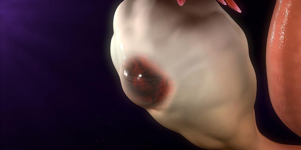 5 способов вылечить кисту яичника без операции