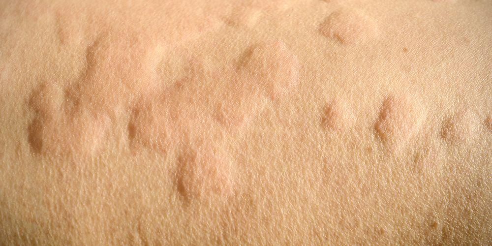 가려움증과 발진이 없는 피부를 위한 5가지 천연 두드러기 치료제
